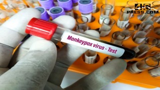 Maymun Çiçeği Virüsü Hakkında Bilinmesi Gereken 5 Nokta